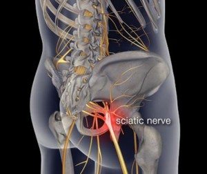 Sciatica-Leg-Pain…-You-don’t-have-to-suffer-300x252